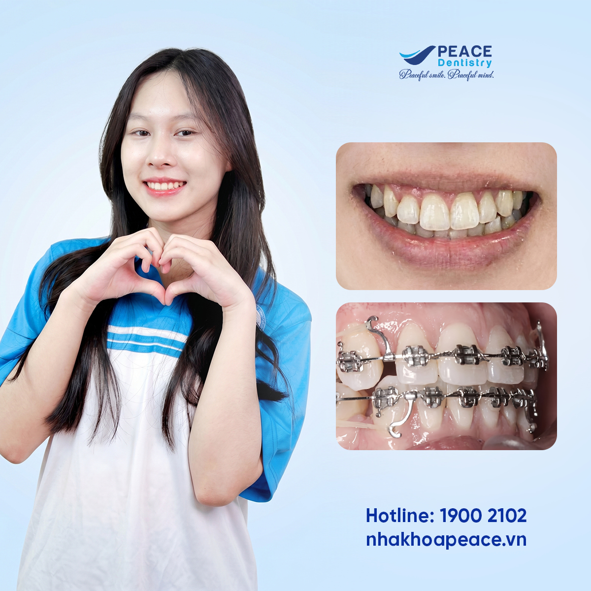 sau khi niềng răng khớp cắn được cải thiện