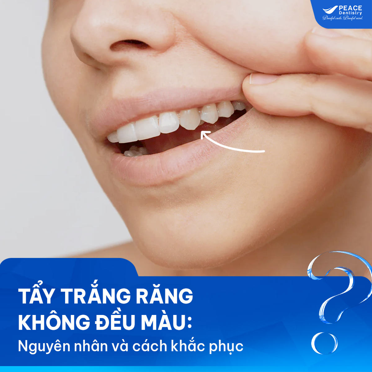 tẩy trắng răng không đều màu