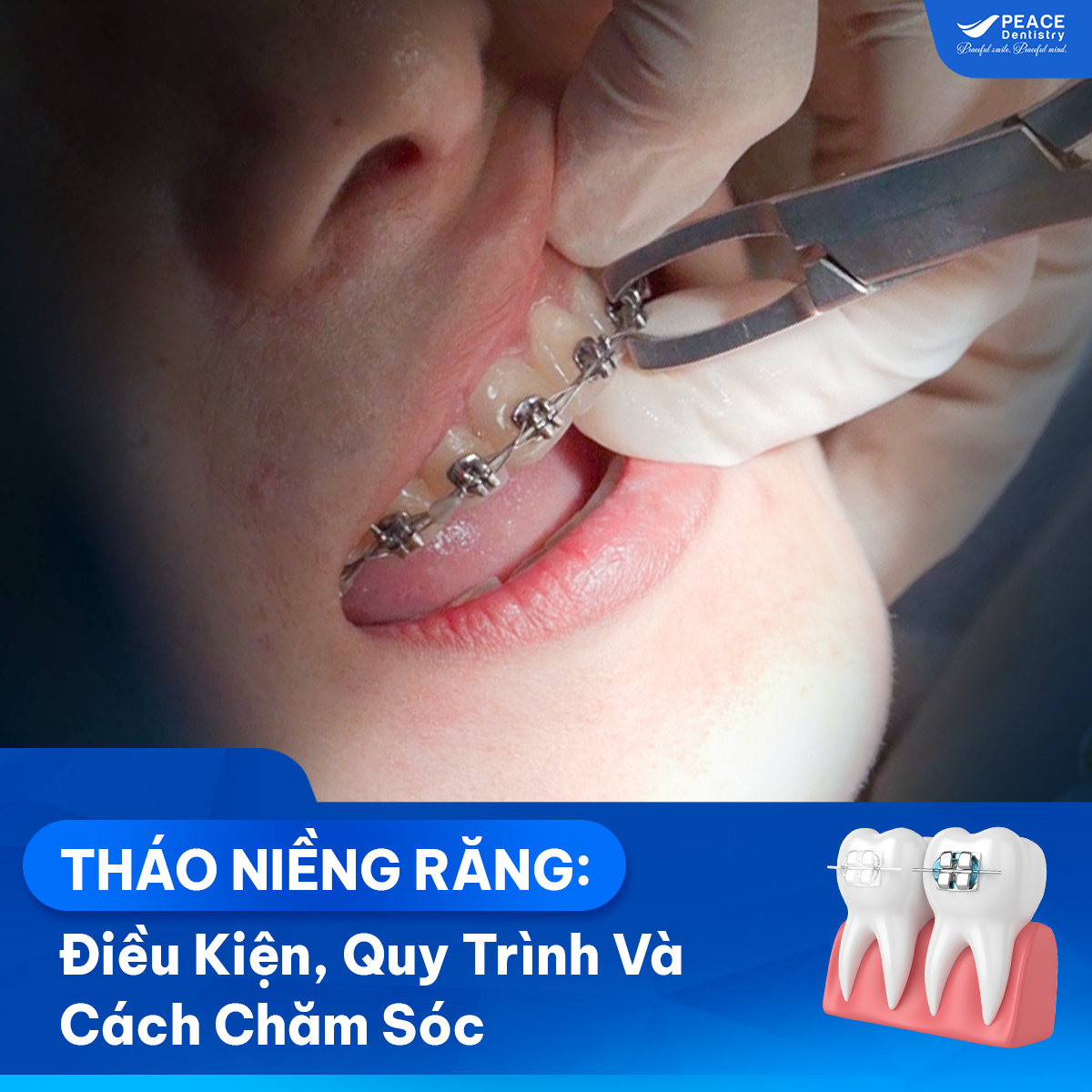 tháo niềng răng