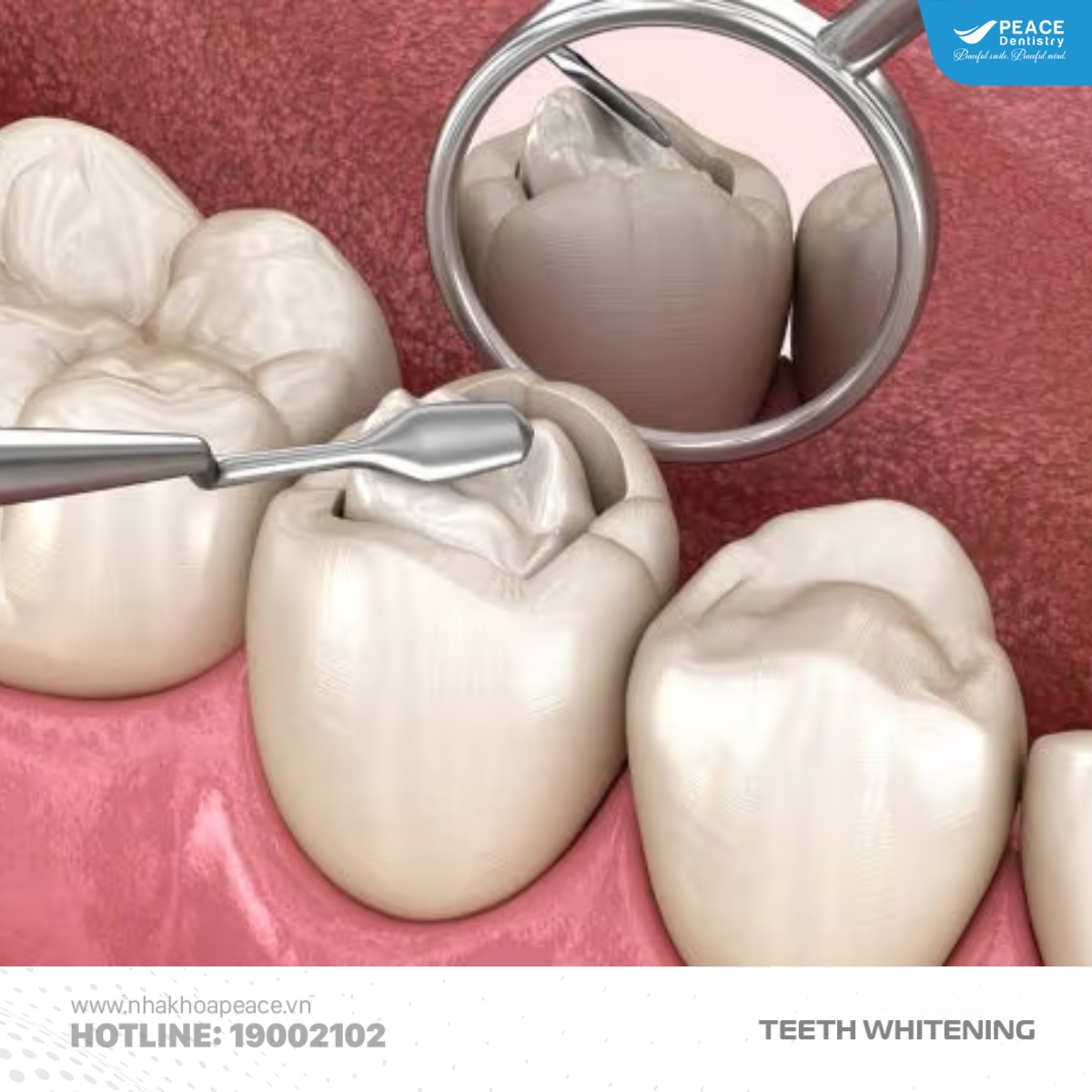 trám răng sâu trước khi tẩy trắng