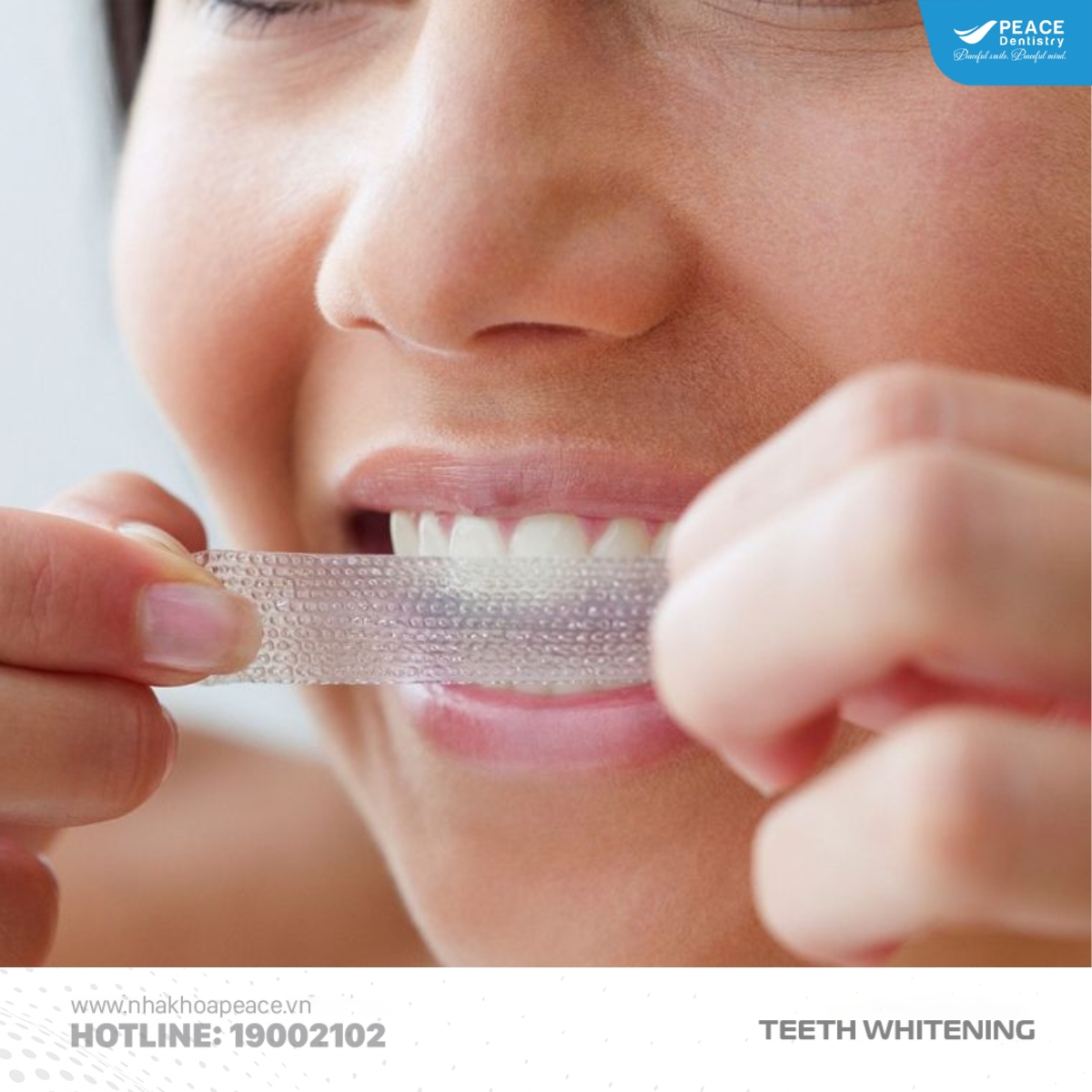 tự tẩy trắng răng tại nhà sai cách