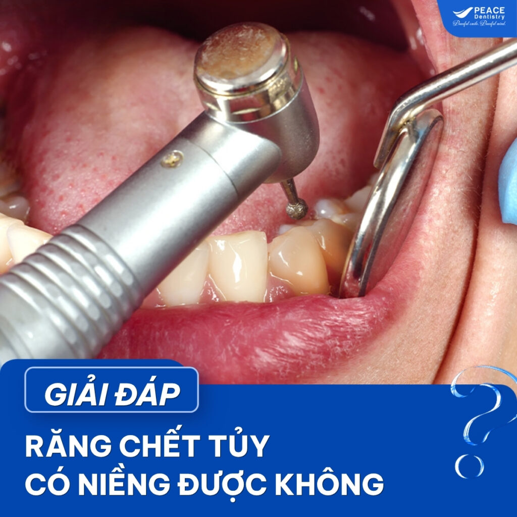 niềng răng bị chết tủy