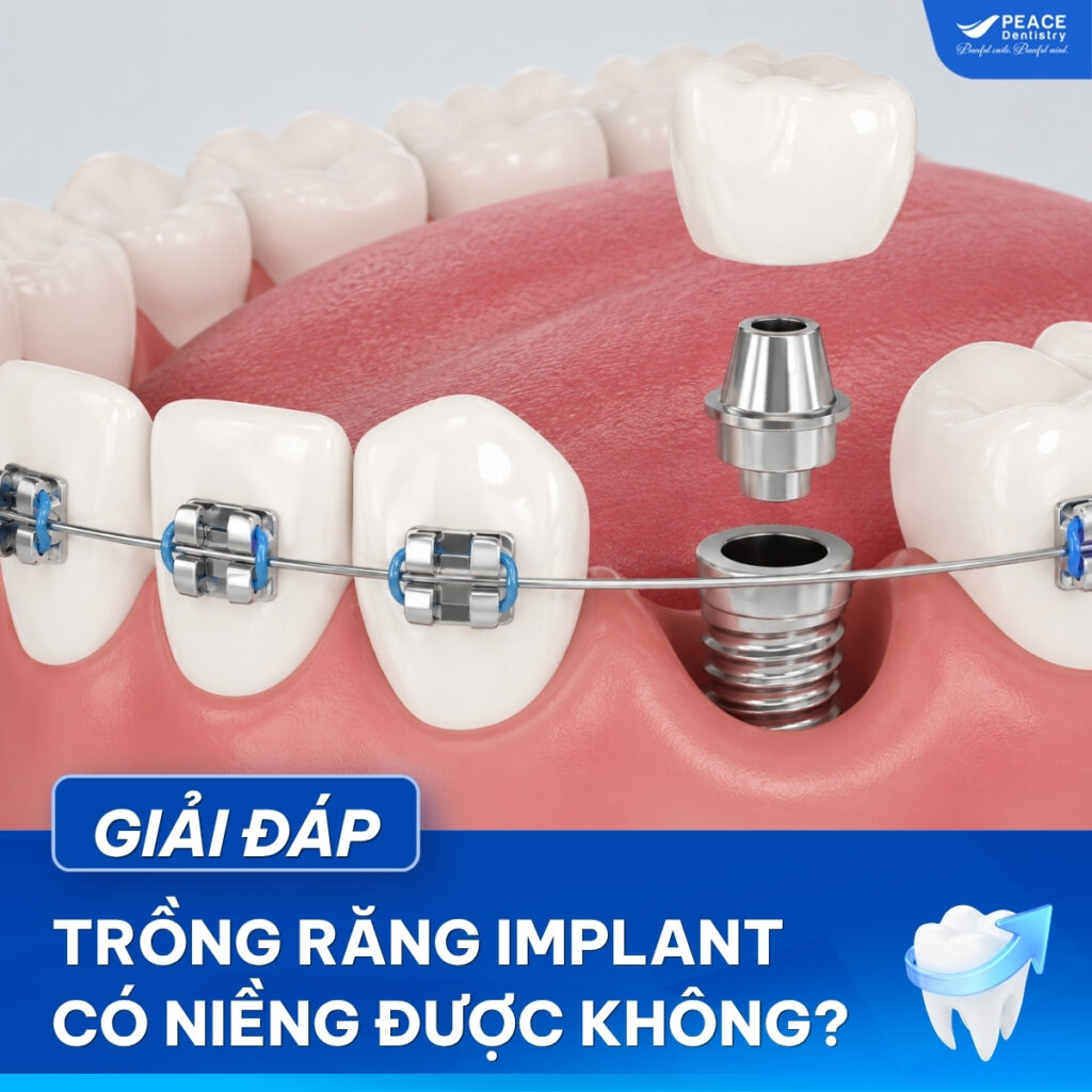 trồng răng implant có niềng được không