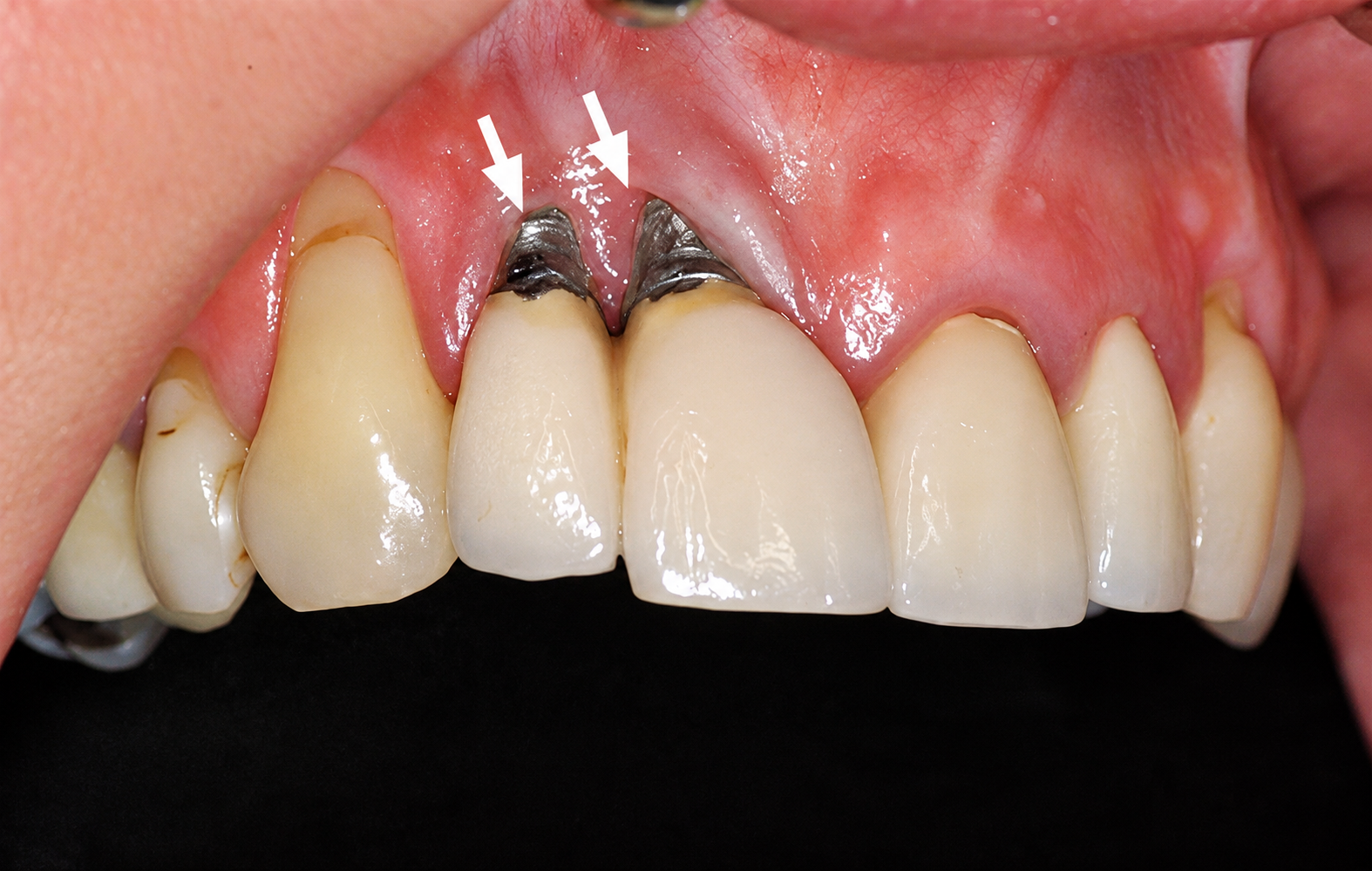 biến chứng do cấy ghép implant sai kỹ thuật