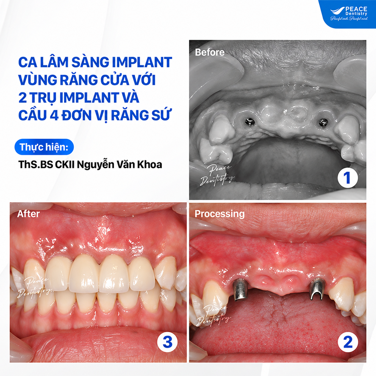 ca lâm sàng implant vùng răng cửa với 2 trụ implant, cầu 4 răng sứ