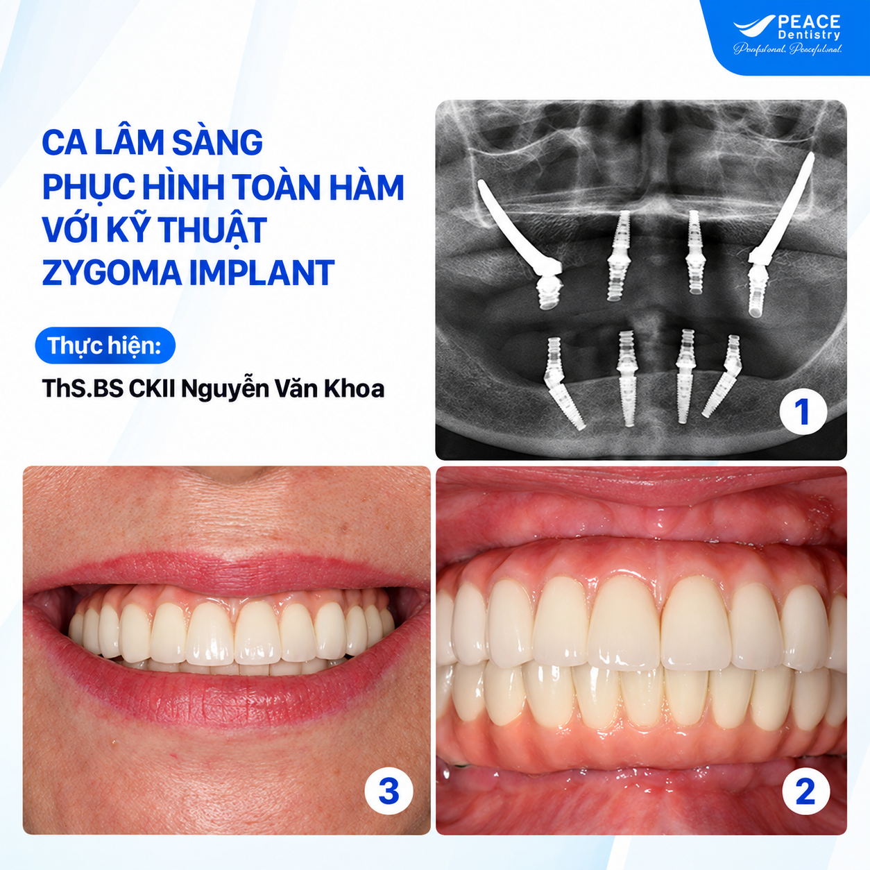 ca lâm sàng phục hình toàn hàm với implant zygoma xương gò má