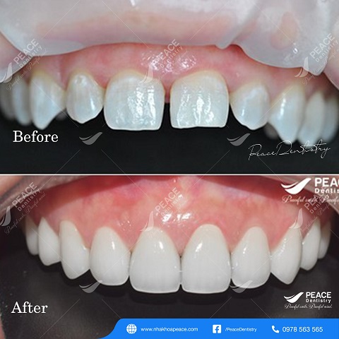 hình ảnh khách hàng bọc răng sứ 33