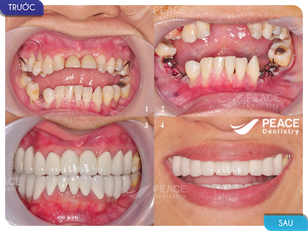 cấy 6 trụ implant và bọc răng sứ cho trường hợp mất răng lâu năm
