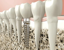 bảo hành implant trọn đời peace dentistry