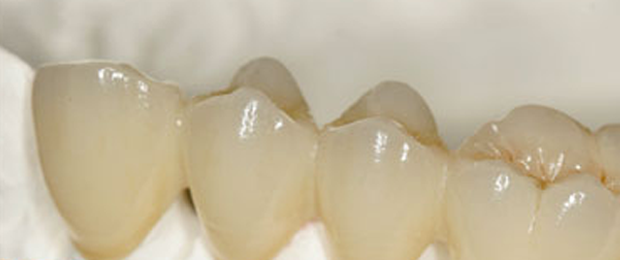 răng sứ titanium sườn kim loại