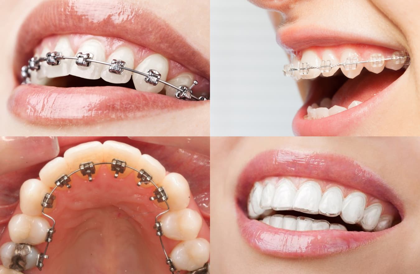 các loại mắc cài niềng răng tại peace dentistry